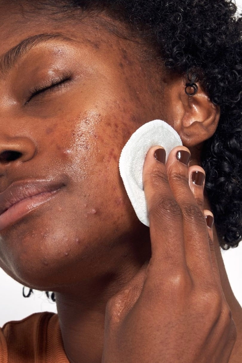 Hyperpigmentation : comprendre et atténuer les taches brunes